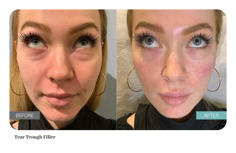 Before and after result